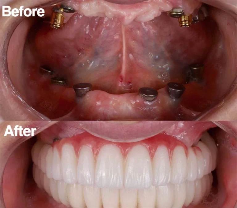 Dental care process at Dr Ankita's Dental Hospital